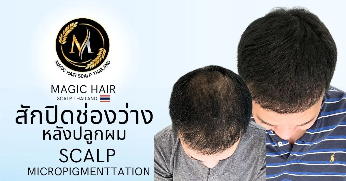 สักปิดช่องว่างหลังปลูกผมเพื่อเพิ่มความหนาแน่นของผม
