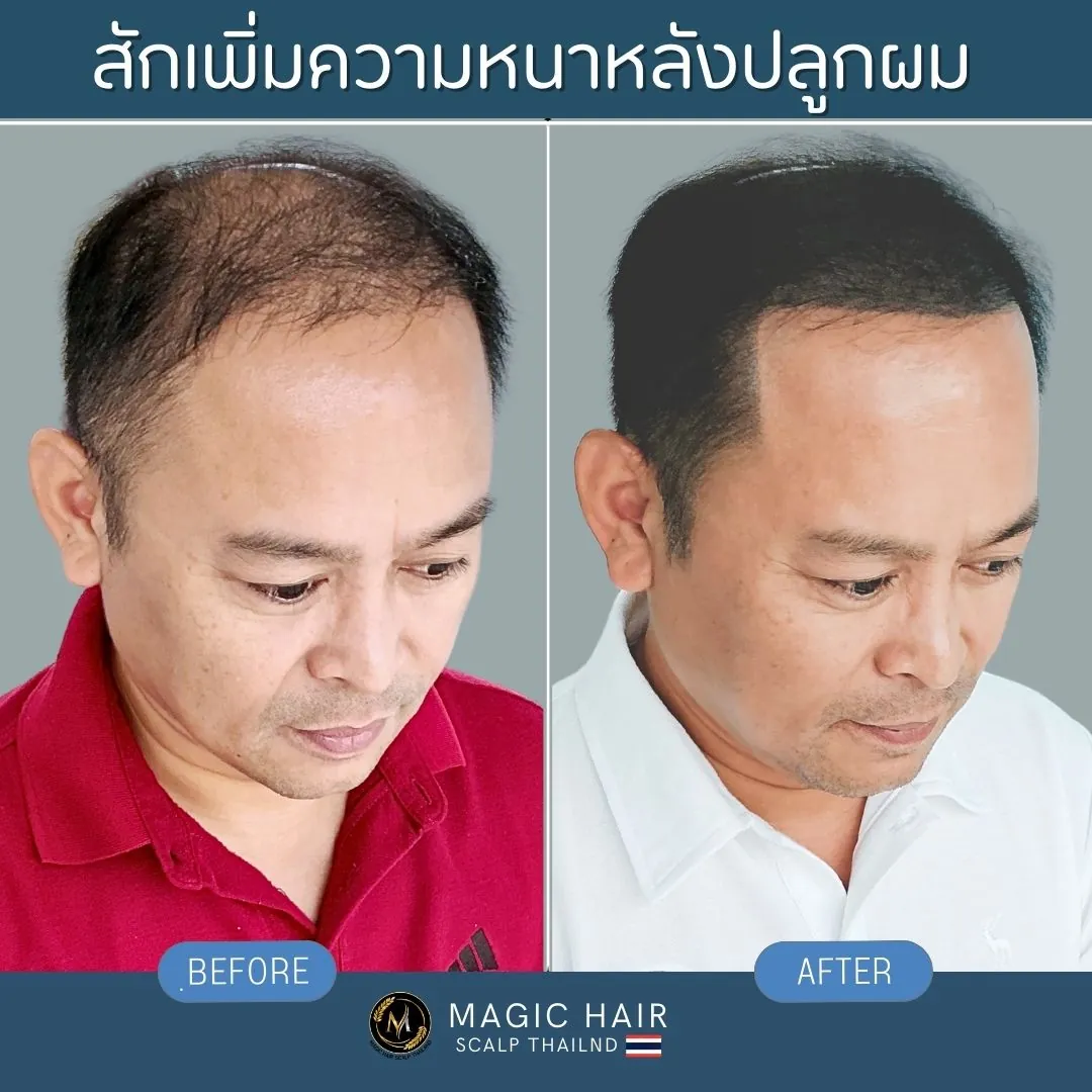 รีวิวสักไรผม SMP เพิ่มความหนาแน่นบริเวณหน้าผากและแนวไรผมผู้ชายหลังผ่านการปลูกผม