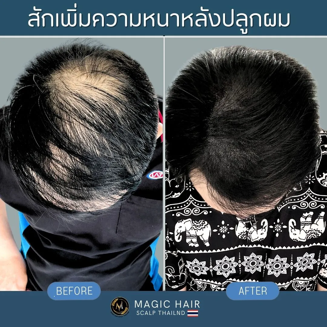 ผลลัพธ์ก่อนและหลังการสักเพิ่มความหนาแน่นให้กับผู้ที่มีปัญหาผมบางกลางศีรษะหลังเข้ารับการปลูกผม