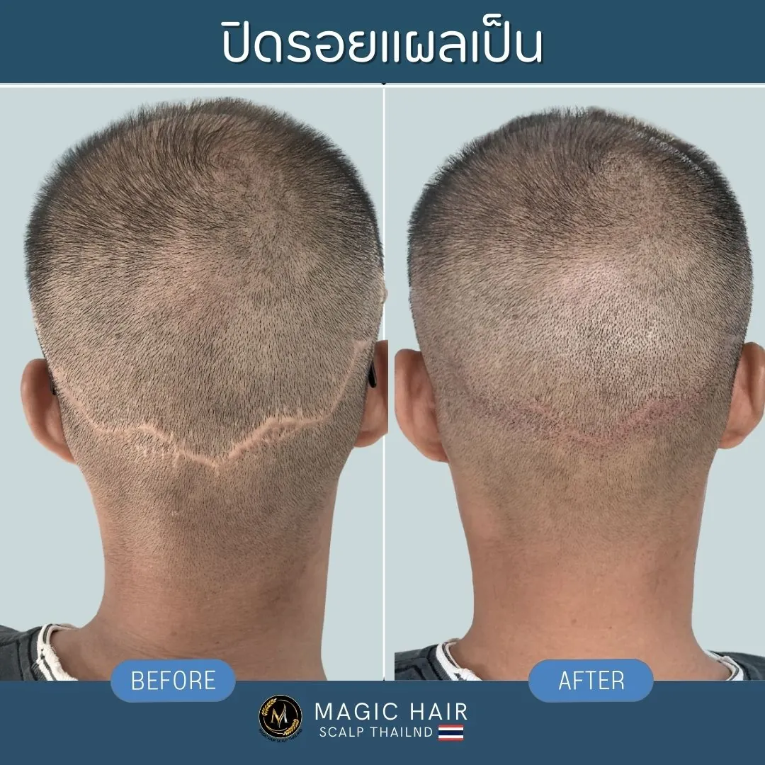 การสักไรผมเทคนิค SMP เพื่ออำพรางและปิดรอยแผลเป็นลายเส้น (FUT) บริเวณท้ายทอยหลังการปลูกผม