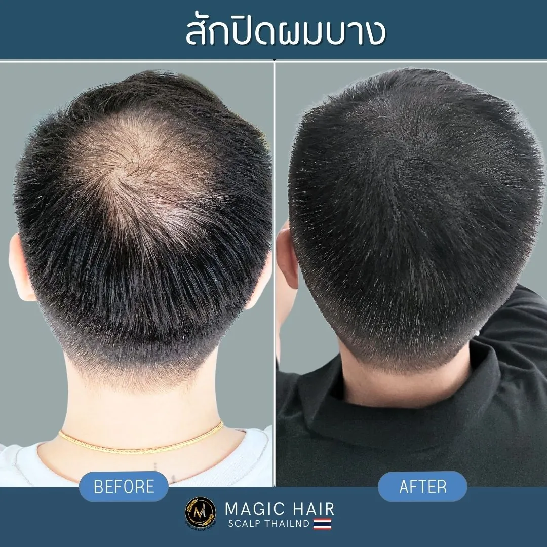 ผลลัพธ์ก่อนและหลังการสักไรผม SMP เพื่อแก้ปัญหาผมบางและปิดหนังศีรษะขาวบริเวณกลางขวัญในผู้ชาย