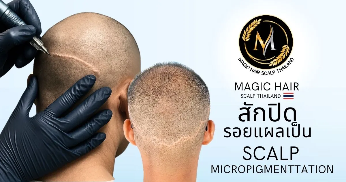 สักปิดรอยแผลเป็นบริเวณหนังศีรษะ