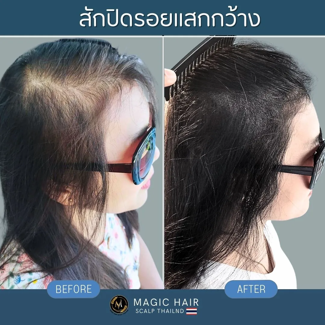รีวิวสักไรผมผู้หญิงเพื่อปิดรอยแสกผมที่กว้าง ช่วยอำพรางหนังศีรษะและทำให้ผมดูหนาขึ้นอย่างเป็นธรรมชาติ